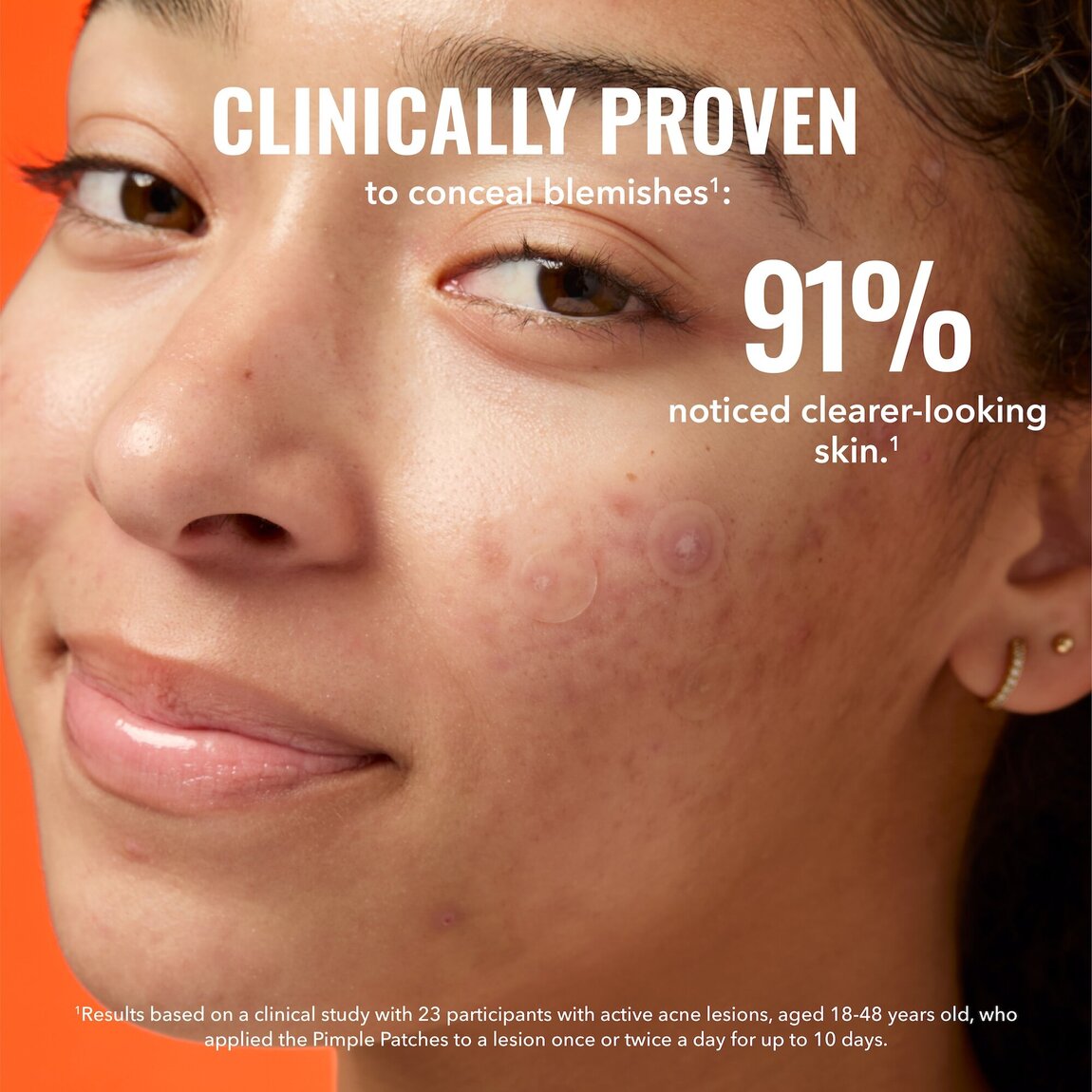 pimple-patches-j0 zb_p.jpg